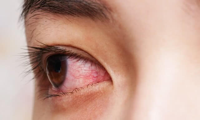 covid-new-syndrome-18-red-eyes