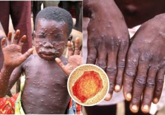 Monkeypox Symptoms And How To Avoid It Feature