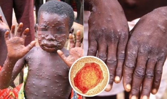 Monkeypox Symptoms And How To Avoid It Feature