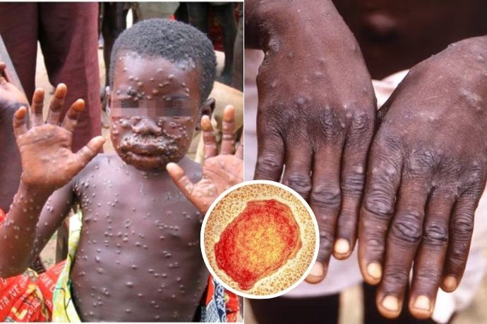 Monkeypox Symptoms And How To Avoid It Feature