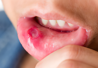 mouth ulcer main photo