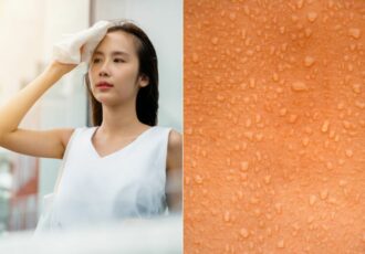 Excessive Sweating Hyperhidrosis Feature