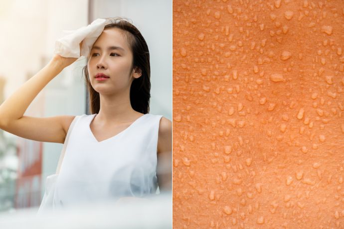 Excessive Sweating Hyperhidrosis Feature