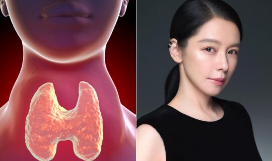 14 Syndrome Of Thyroid