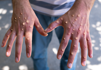Two Confirmed Cases Of Monkeypox In Malaysia And What Are The Symptoms