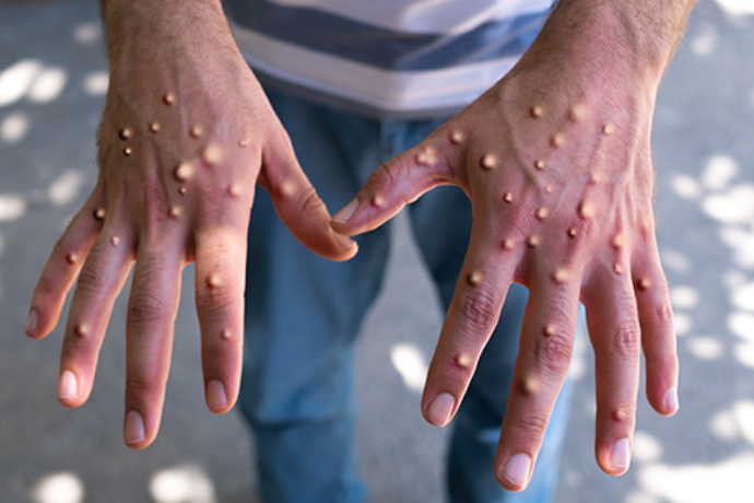 two-confirmed-cases-of-monkeypox-in-malaysia-and-what-are-the-symptoms