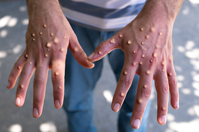 Two Confirmed Cases Of Monkeypox In Malaysia And What Are The Symptoms