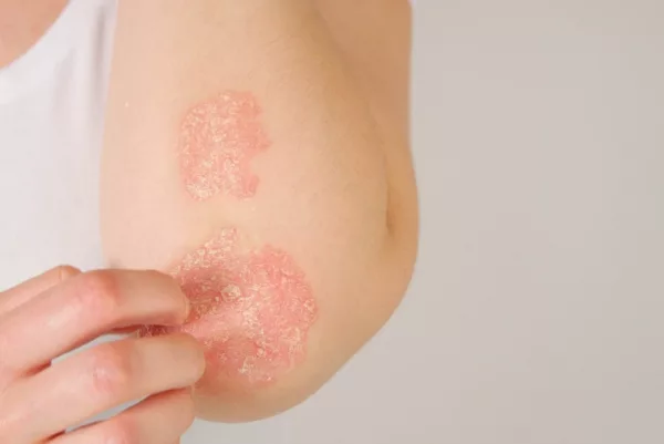 Eczema Skin Problem 1