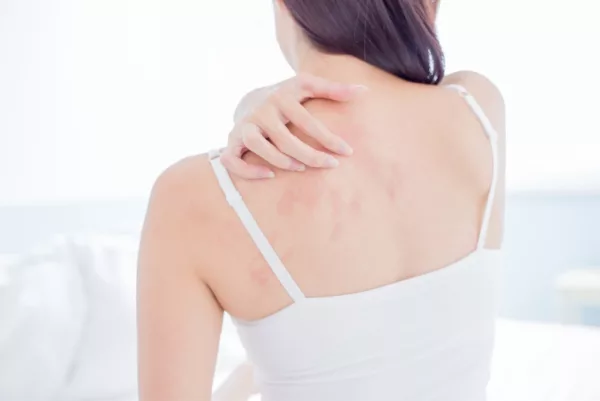Eczema Skin Problem 2