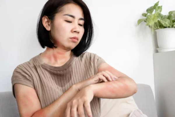 Eczema Skin Problem 3