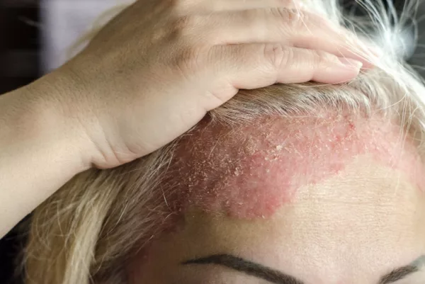 Eczema Skin Problem 4