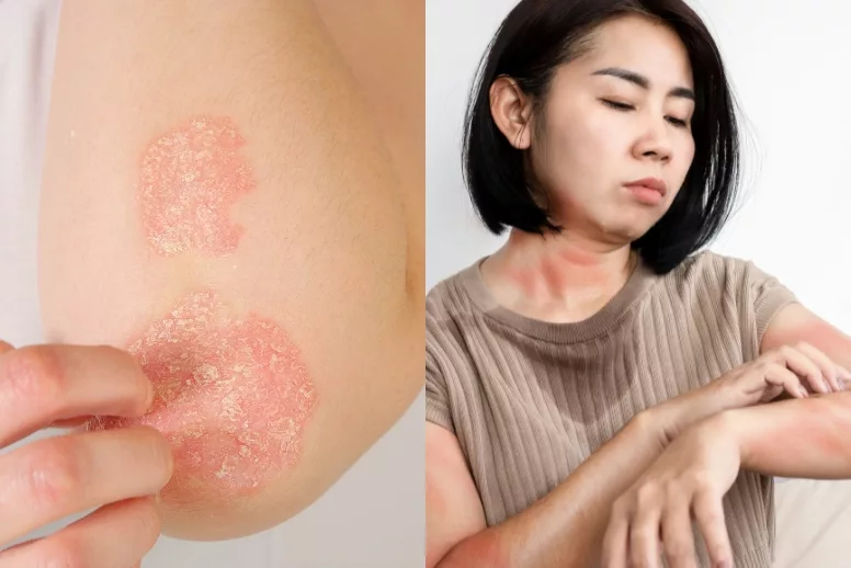 Eczema Skin Problem 6