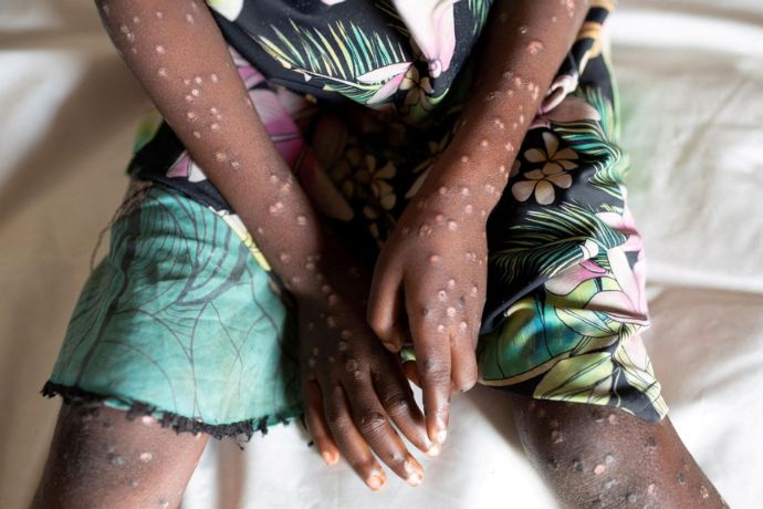 All About Mpox