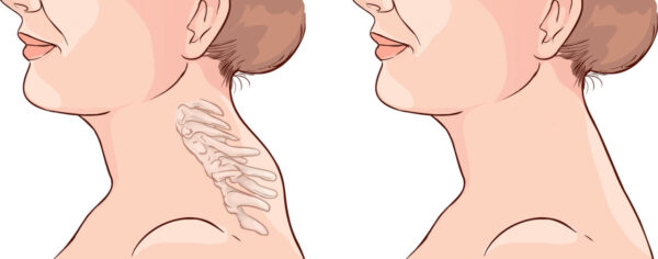 Whats Is Neck Hump And How To Solve7