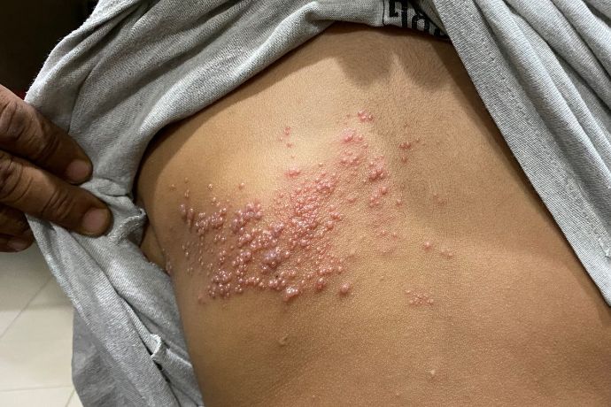 Varicella Zoster Virus