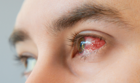 Eyes Red Blood Vessels Main Photo
