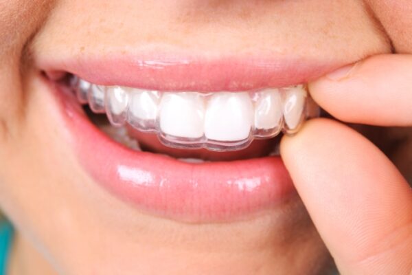 Why Need To Wear Retainer After Orthodontics4
