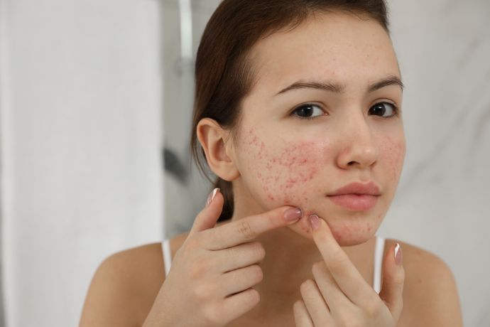 Want Clear Skin Eat Less Of These Foods!