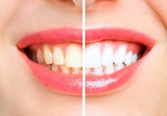 4 habits that make teeth yellow (1)