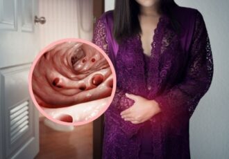 Understanding Colonic Diverticular Disease