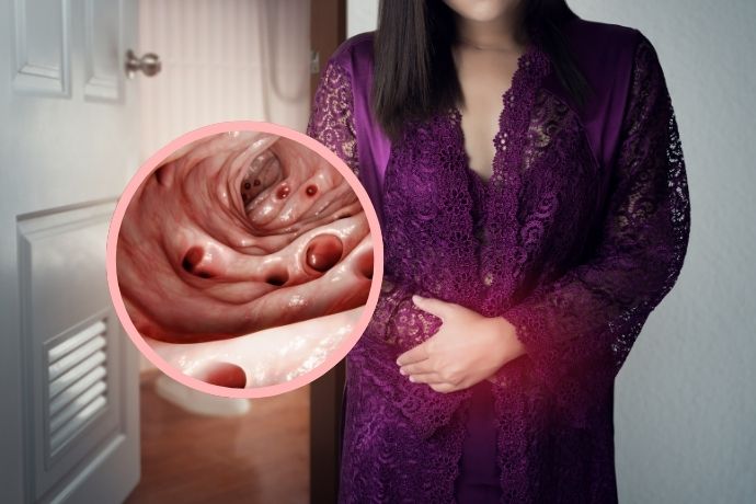Understanding Colonic Diverticular Disease